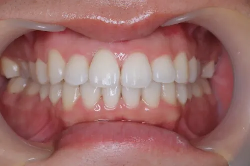 ホワイトニング症例 after
