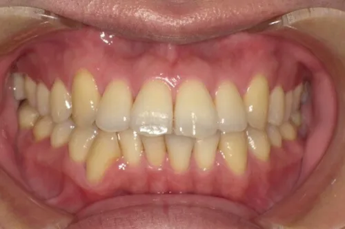 ホワイトニング症例 before
