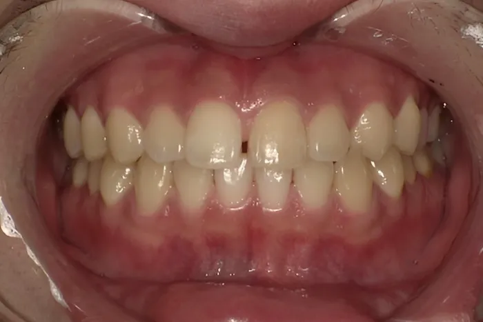 ホワイトニング症例 before