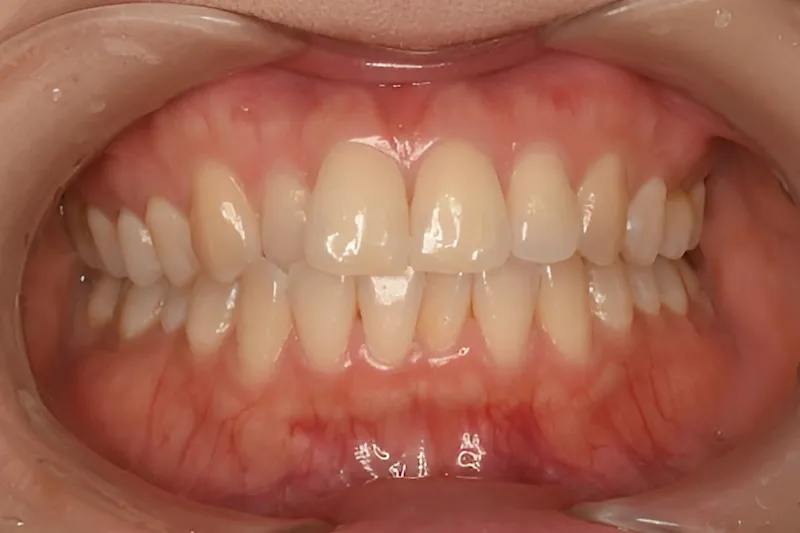 ホワイトニング症例 before