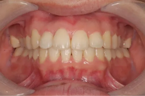 ホワイトニング症例 before