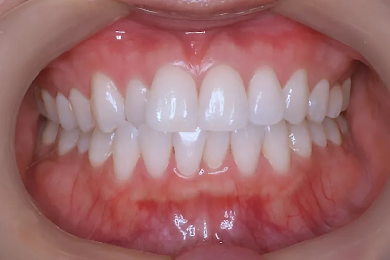 ホワイトニング症例 after