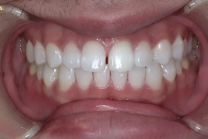 ホワイトニング症例 after