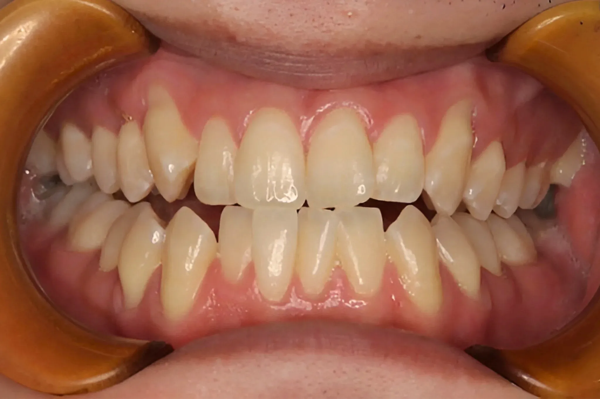 ホワイトニング症例 before