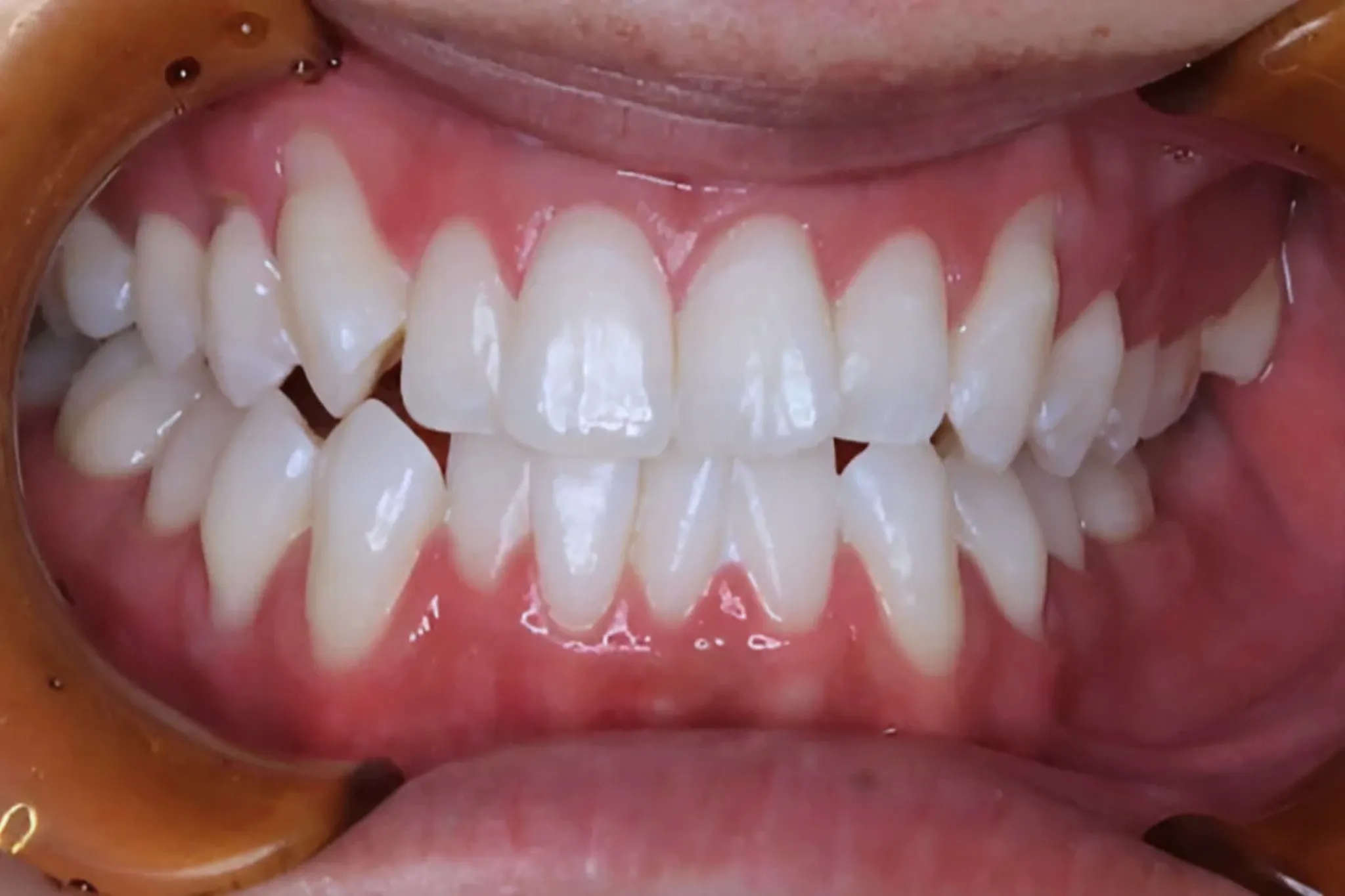 ホワイトニング症例 after