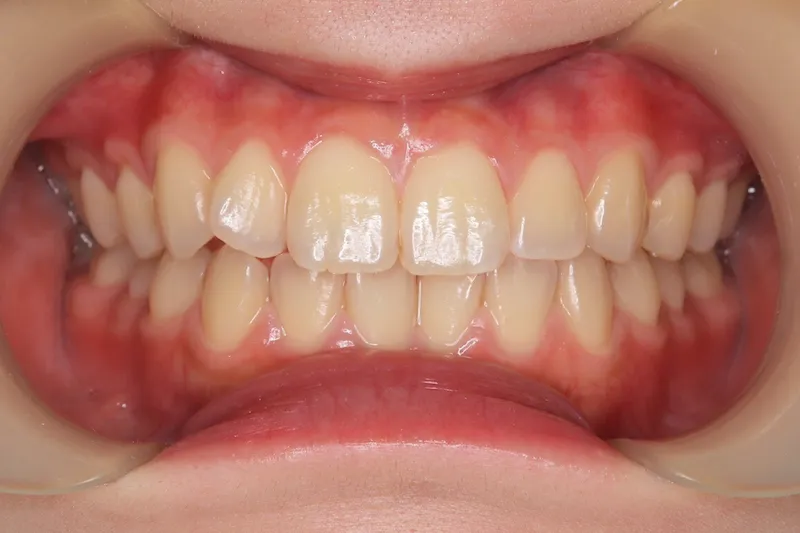 ホワイトニング症例 before