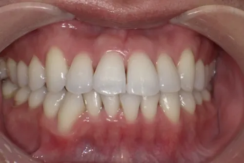 ホワイトニング症例 after