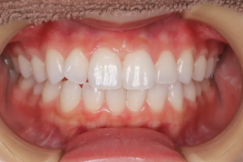 ホワイトニング症例 after