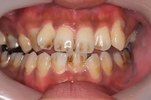 クリーニング症例 before 