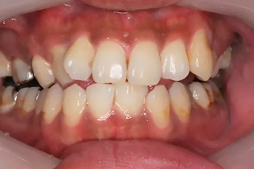 クリーニング症例 after