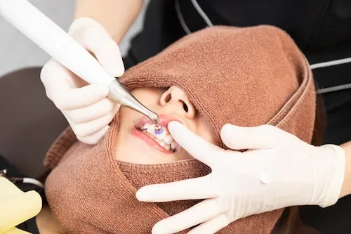 マイクロアブレージョン