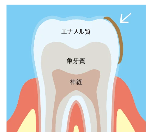 歯の表面の着色、ステイン、ヤニ