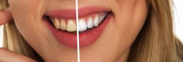 ボーテの歯のクリーニングの特徴とは？