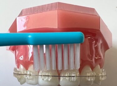 矯正治療中の歯磨き・ブラッシング方法とは？