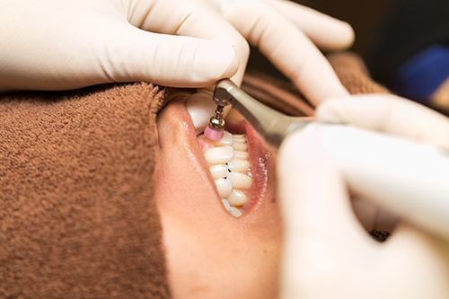 歯の表面の掃除
