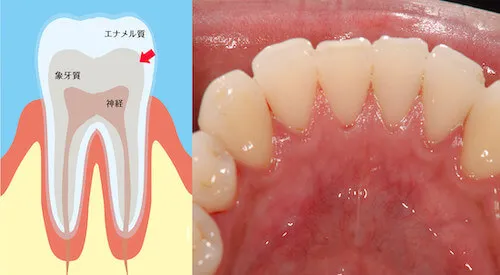 歯の内部の象牙質の黄ばみ