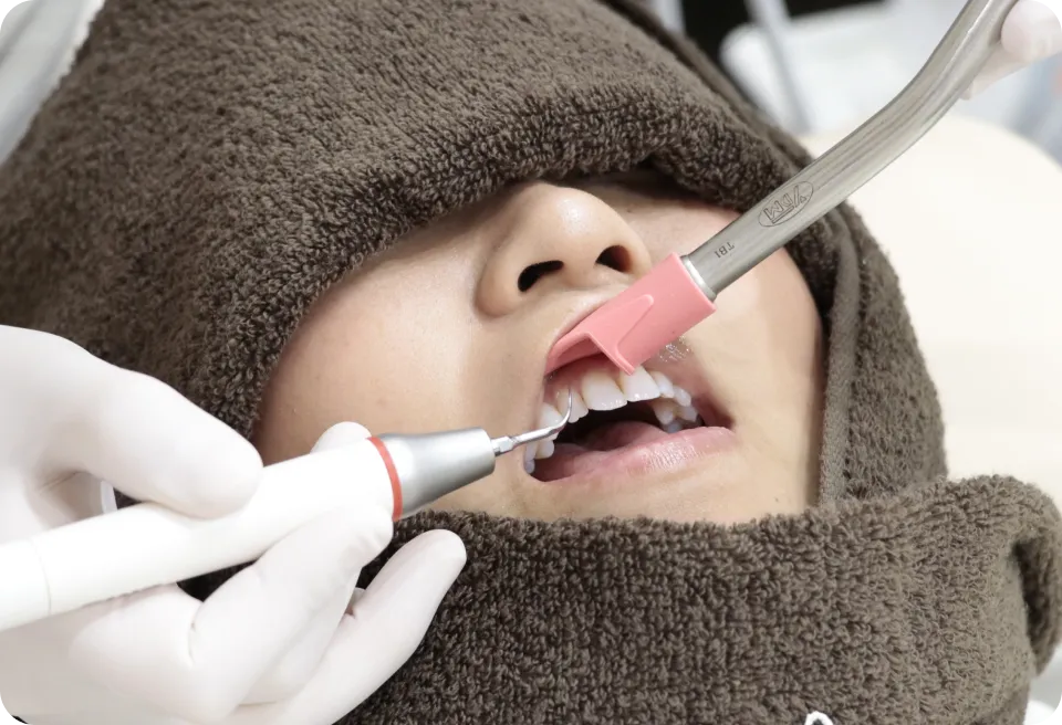 歯にこびりついた歯垢・歯石をごっそり除去