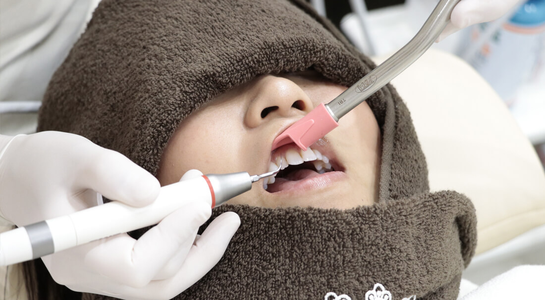 歯石歯垢除去する歯のクリーニング