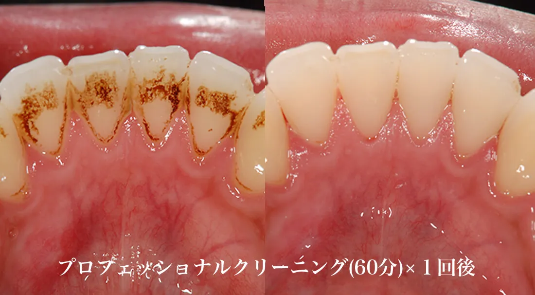 歯のヤニ着色除去のクリーニング効果