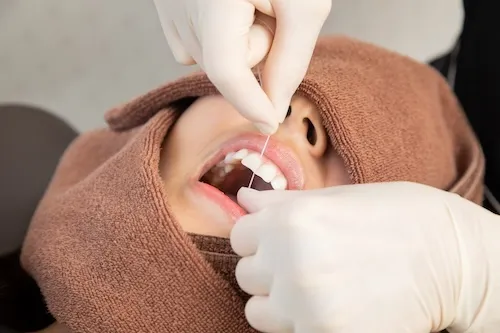 歯のクリーニング
