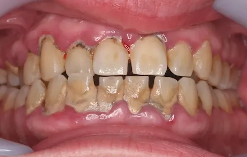 クリーニング症例 before 