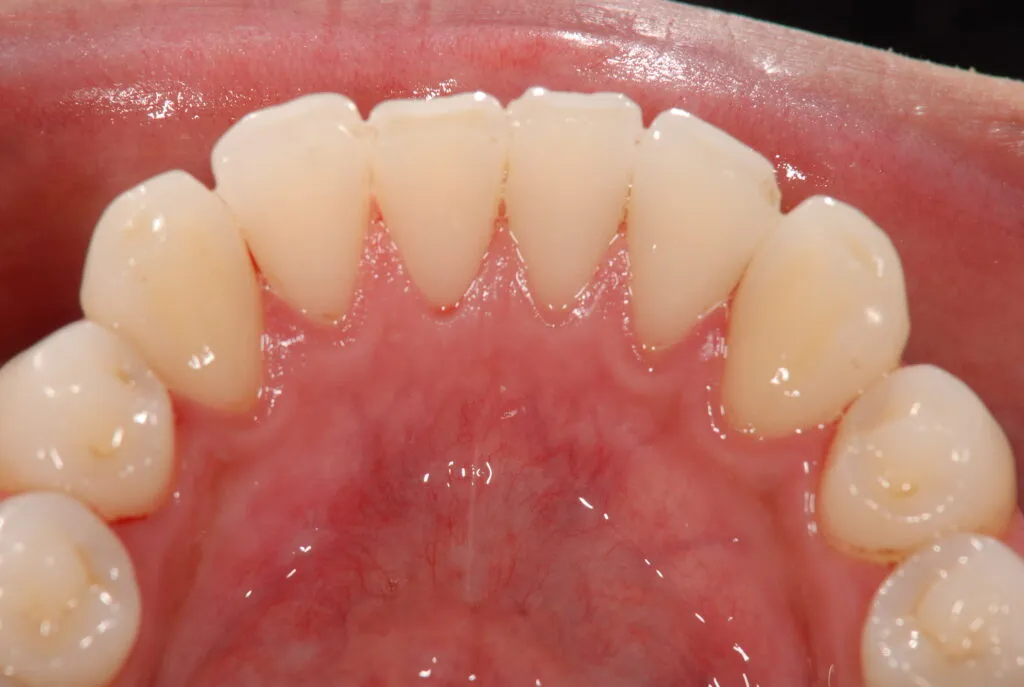 クリーニング症例やニトリ術後