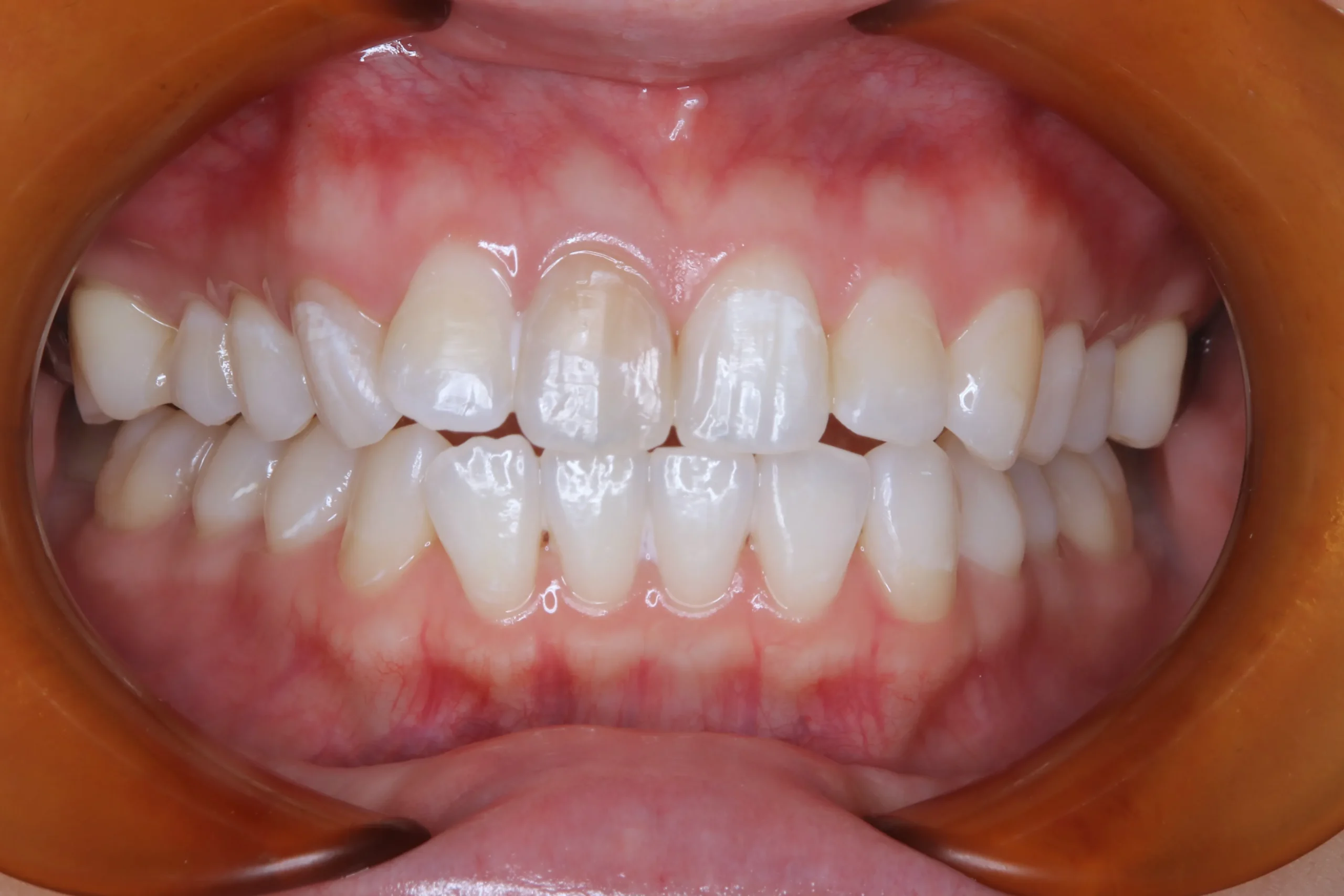 神経を取った歯の変色が気になる方へ 周囲の歯も一緒に白くするホワイトニング症例