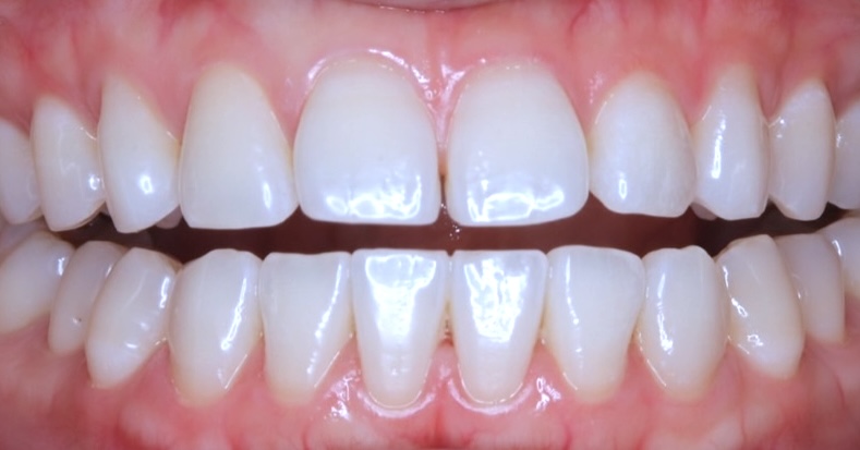 結婚式まで4ヶ月でブリーチシェードへ 20代女性のブライダルホワイトニング症例