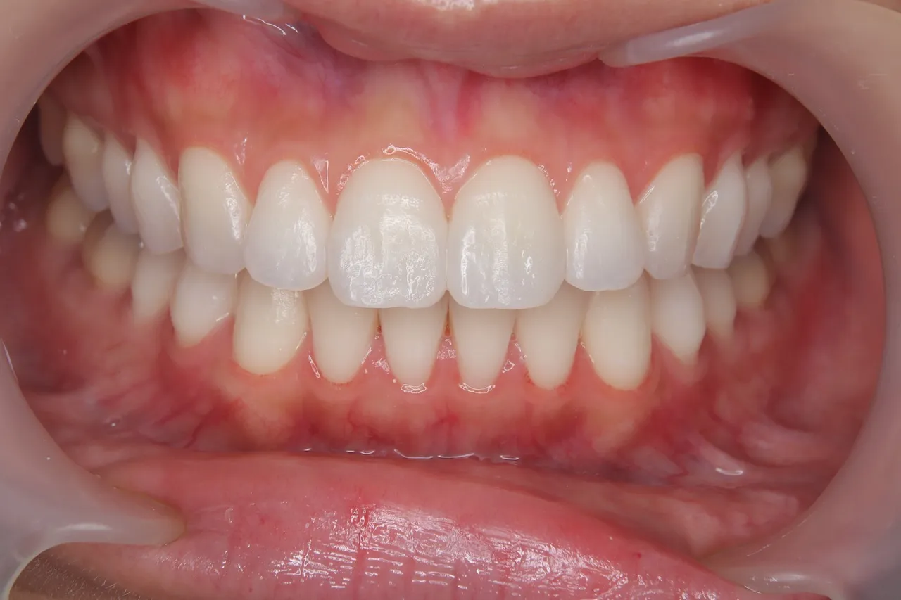 結婚式で自信のある笑顔へ 黄ばみを克服したブライダルホワイトニング症例