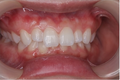 40代女性が医療ホワイトニングでブリーチシェードBL3を達成