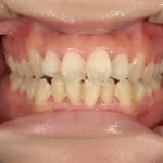 ホワイトニング施術前の歯の黄ばみがわかる症例写真