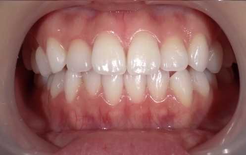 結婚式まで3ヶ月で理想の白さへ 20代女性のブライダルホワイトニング症例紹介