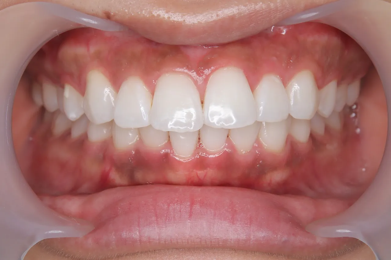 40代からでもここまで白くなる｜ホワイトニングサロンBeauteで叶えたブリーチシェードへの道