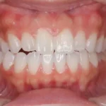 医療ホワイトニング施術後に歯が明るくなった症例写真