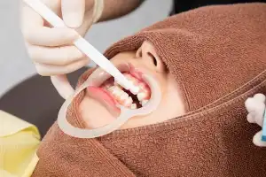 ホワイトニング剤を塗布する施術イメージ