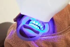 短期集中で白さを目指すオフィスホワイトニング