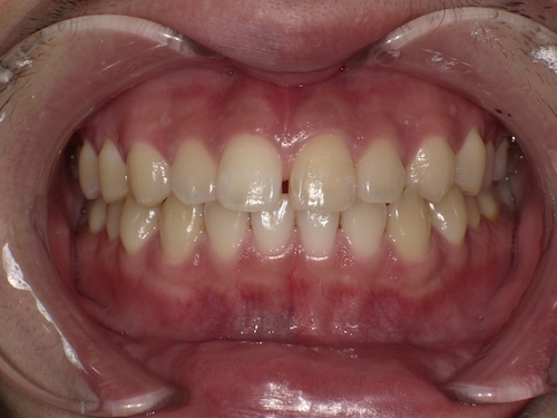 前歯の帯状の変色をホワイトニング