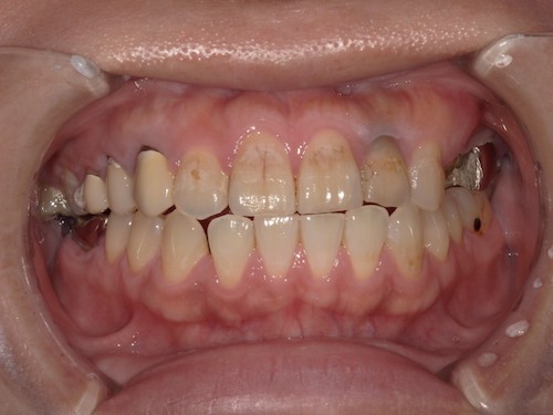 前歯の帯状の変色
