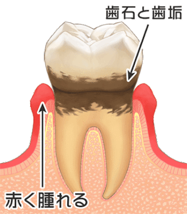 歯周病はどんな病気？歯のクリーニングで予防しましょう